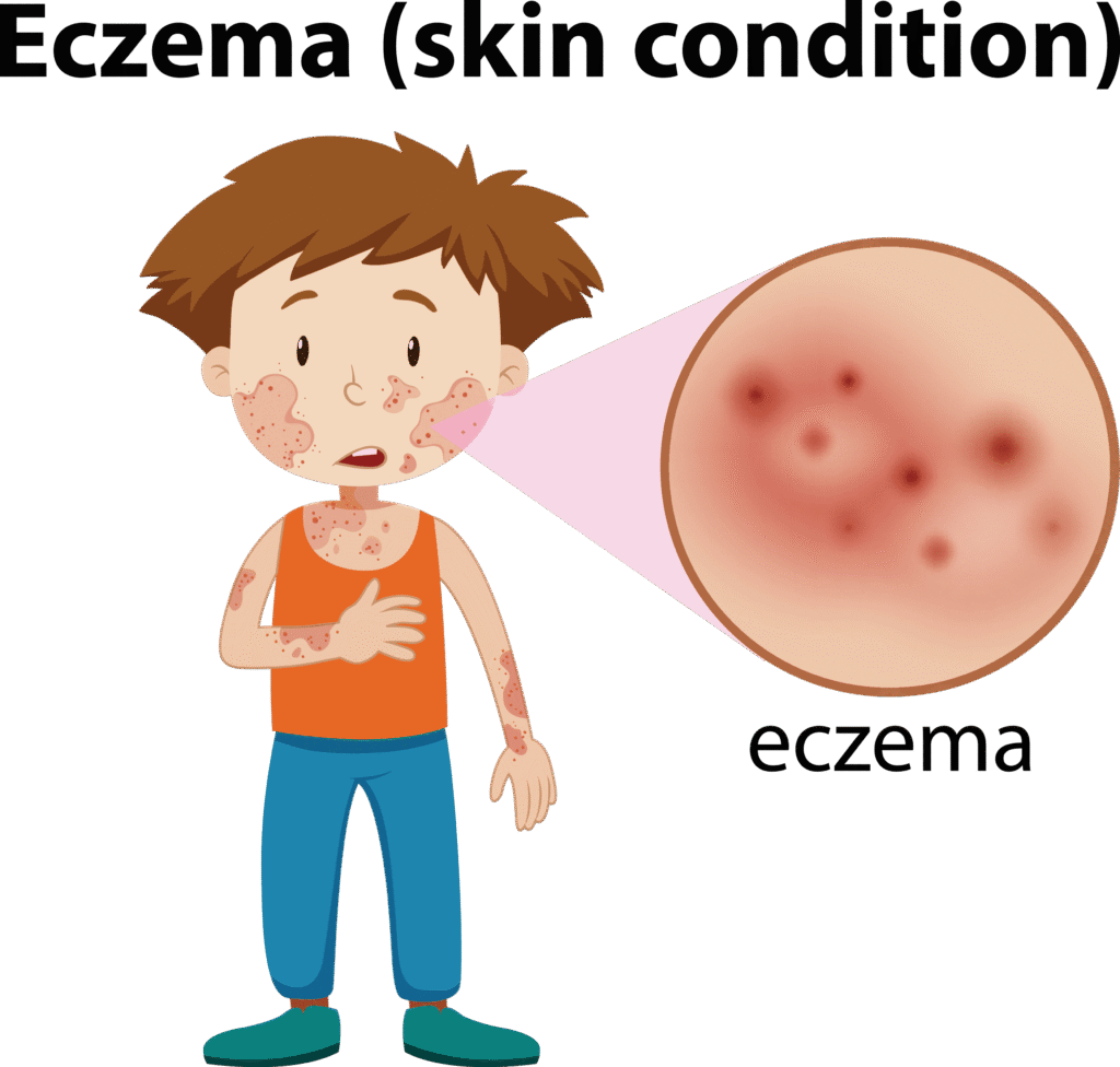 eczema