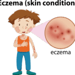 eczema