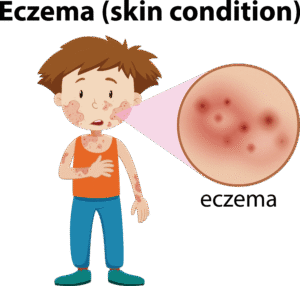 eczema